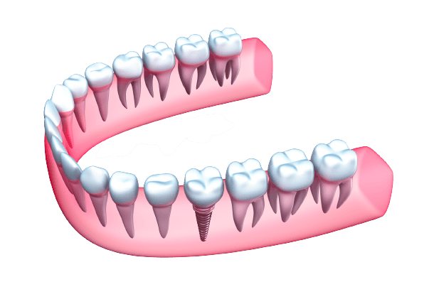 Dental implant illustration