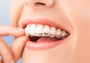 Can Invisalign clear aligners really realign my teeth?