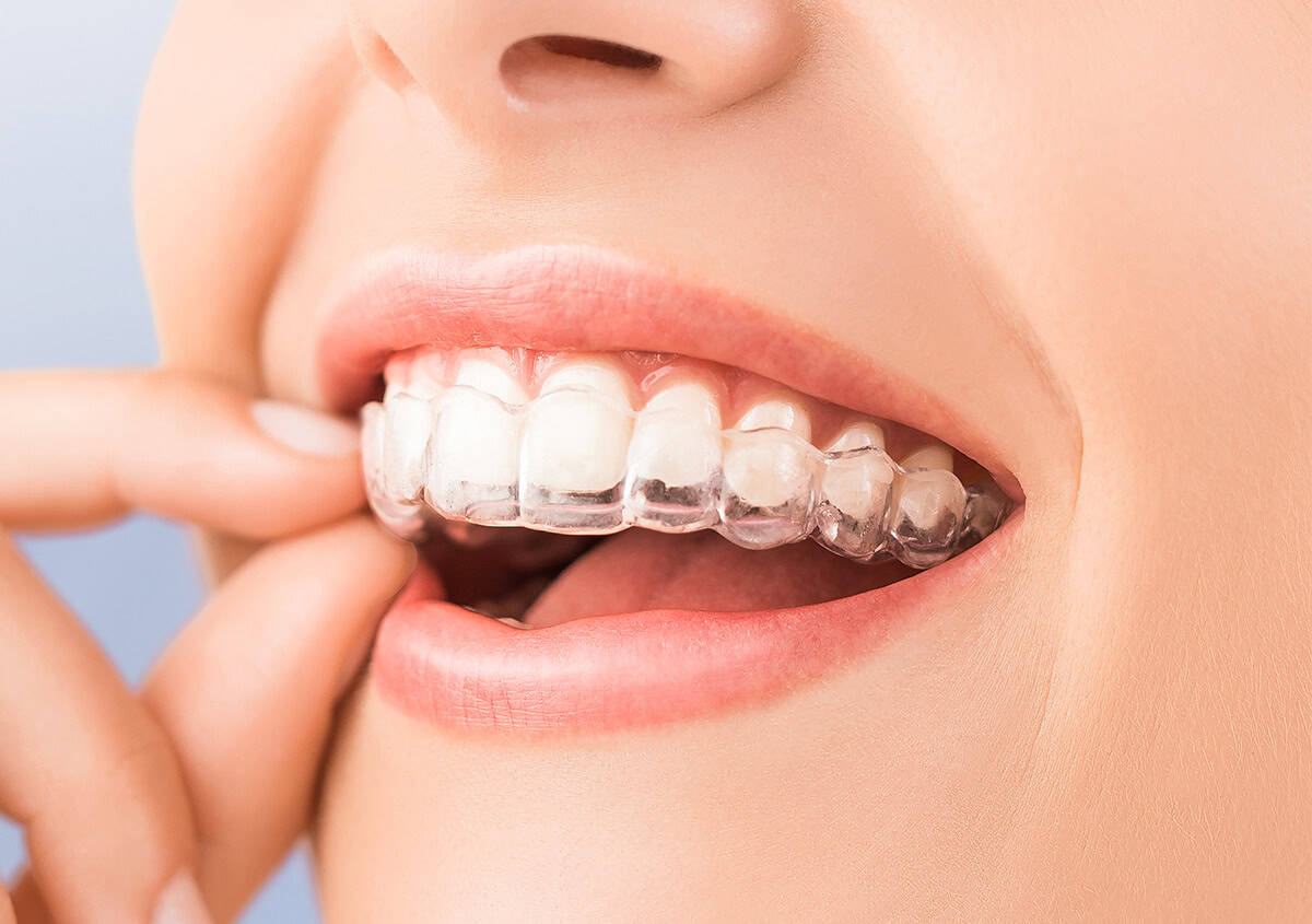 Invisalign Clear Aligners in Valley Village CA Area