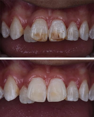 Icon Resin Infiltration before & after treatment results - Case 1