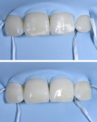 Icon Resin Infiltration before & after treatment results - Case 2